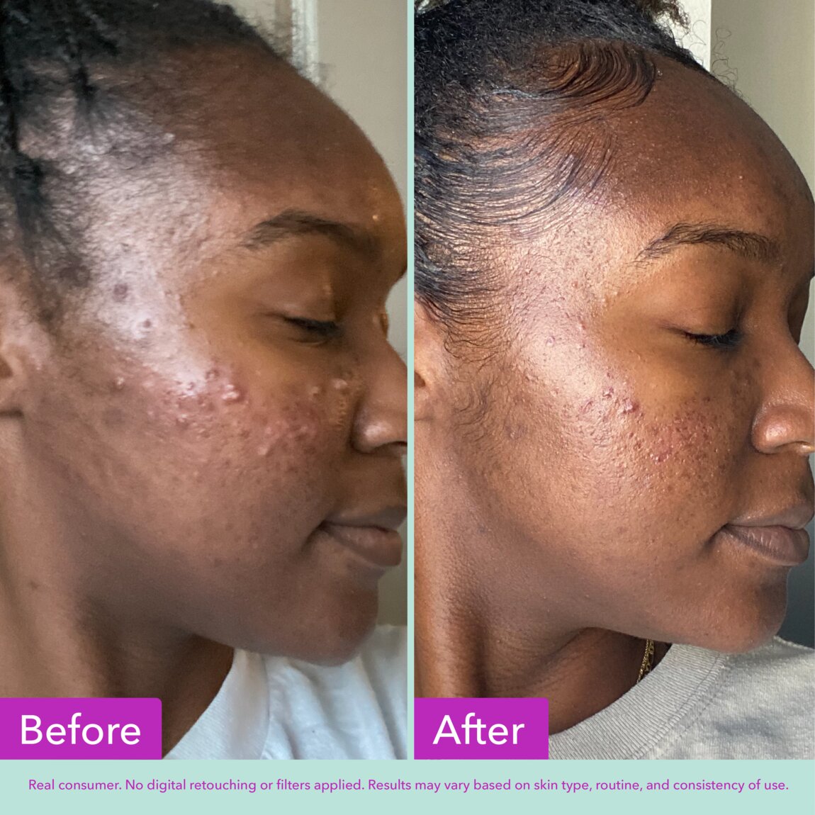 acne-foaming-cleanser-t6 zb_p.jpg
